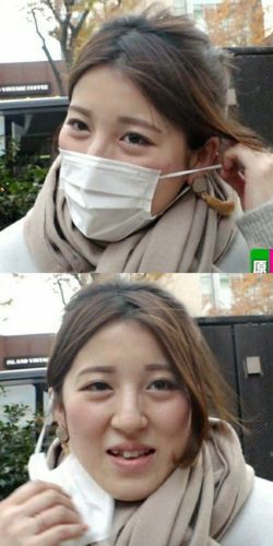 【海外】中国の女優、美容整形の失敗をSNSで公表、鼻先が壊死